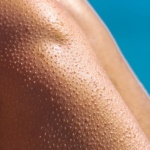 Adieu boutons après l’épilation : prévenir et calmer la folliculite en douceur