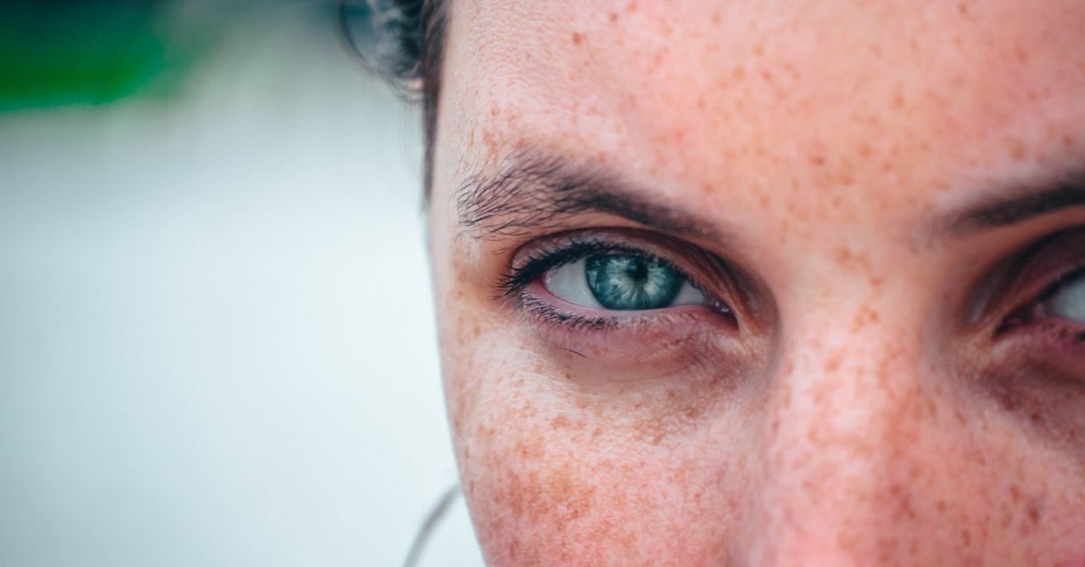 Mélasma du visage : les meilleures solutions pour atténuer les taches et retrouver un teint uniforme